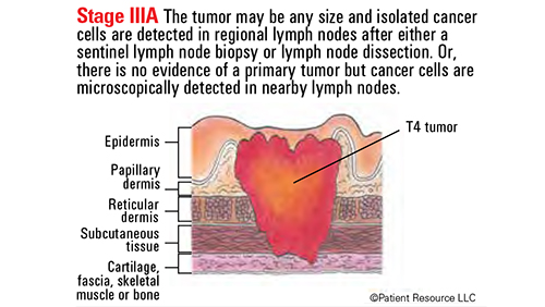 Skin Cancer Staging